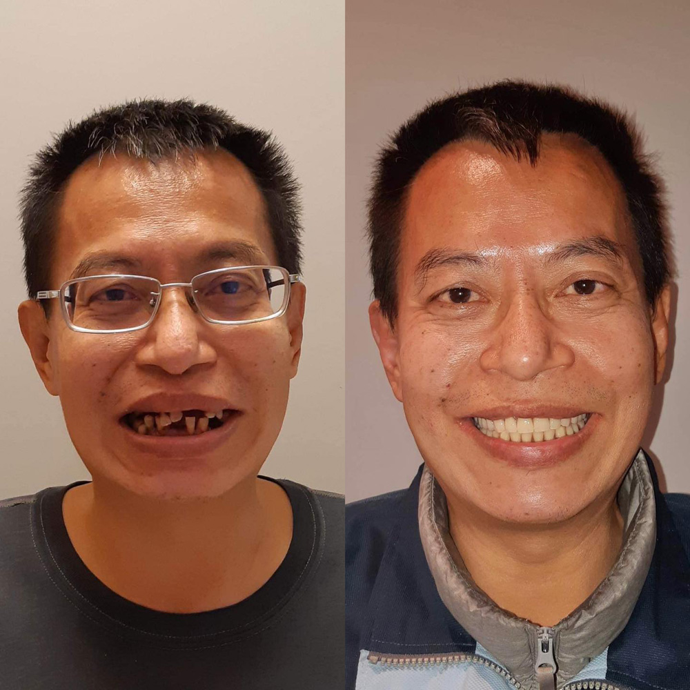 全口重建(All on 4/6) 案例