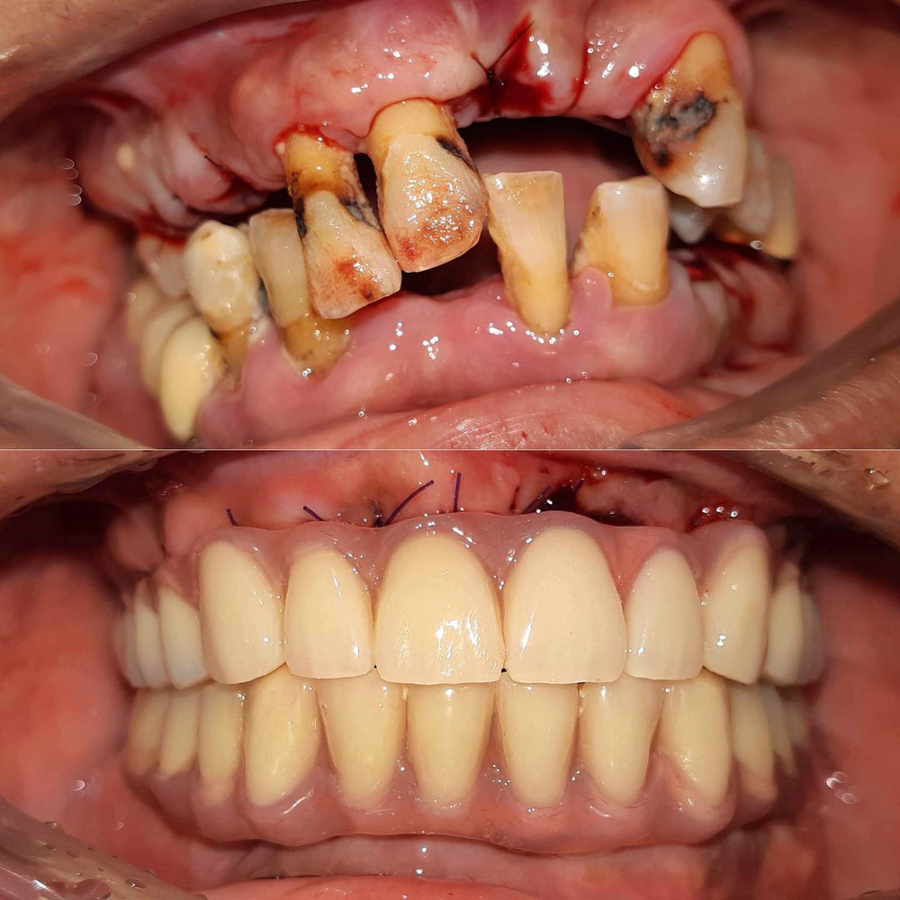 全口重建(All on 4/6) 案例