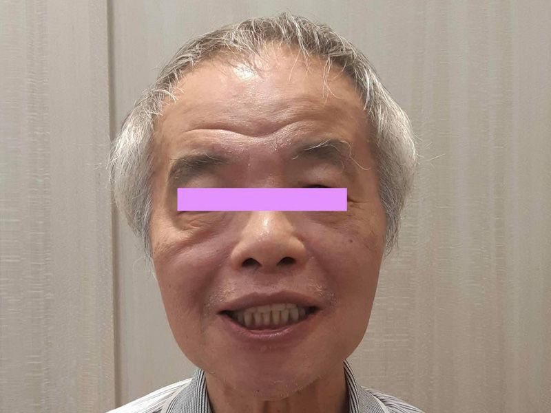 全口重建(All on 4/6) 案例