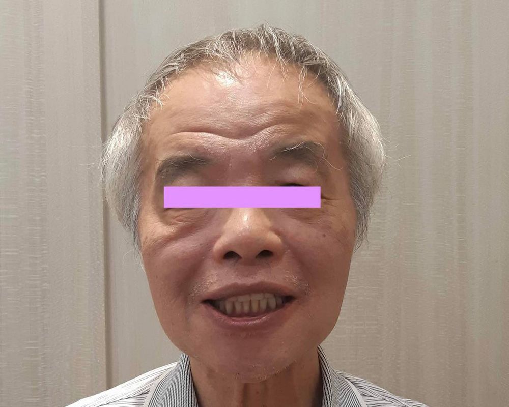 全口重建(All on 4/6) 案例