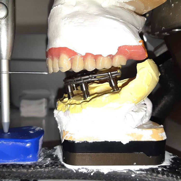 全口重建(All on 4/6) 案例