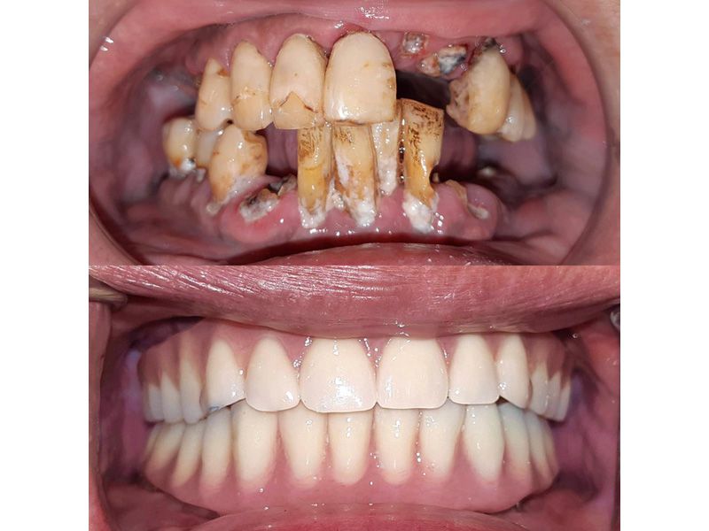 全口重建(All on 4/6)