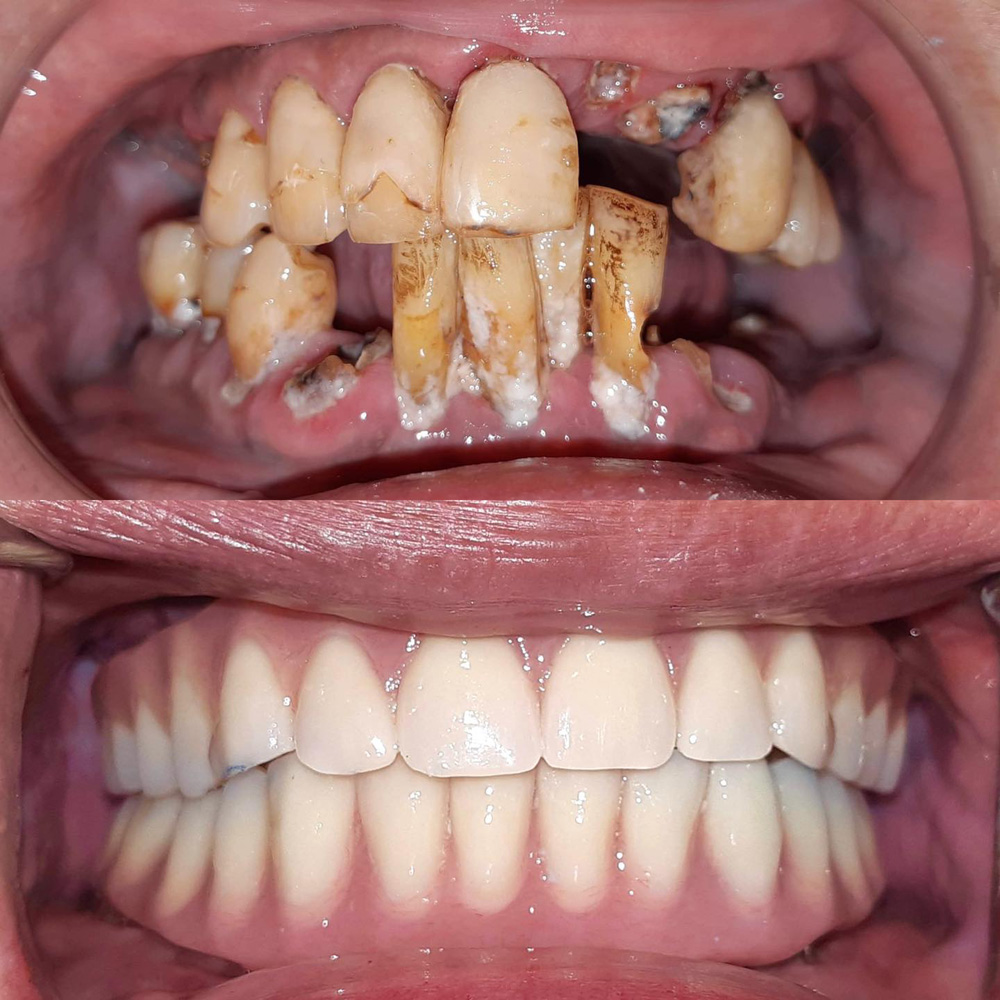 全口重建(All on 4/6) 案例