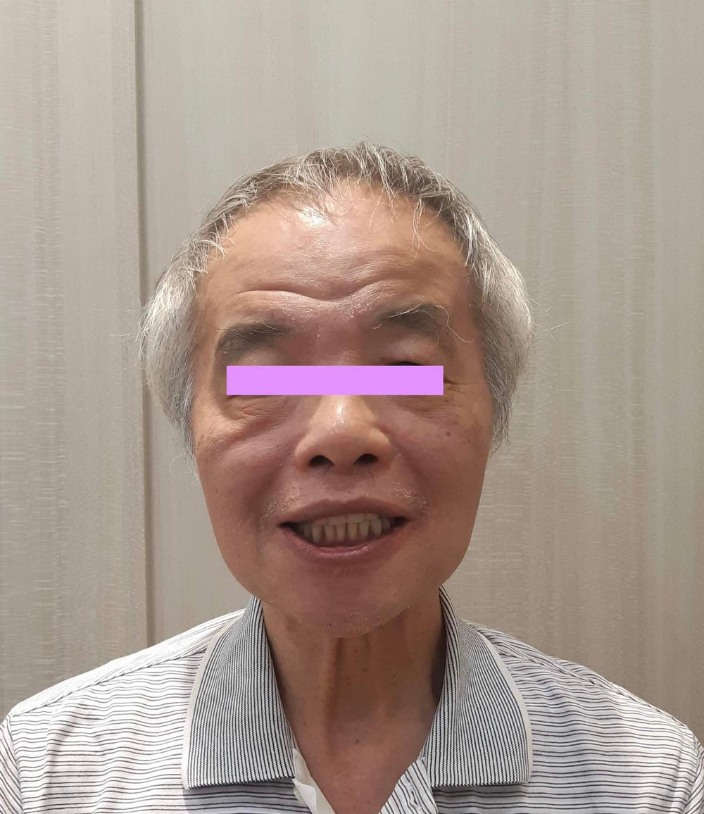 全口重建(All on 4/6) 案例