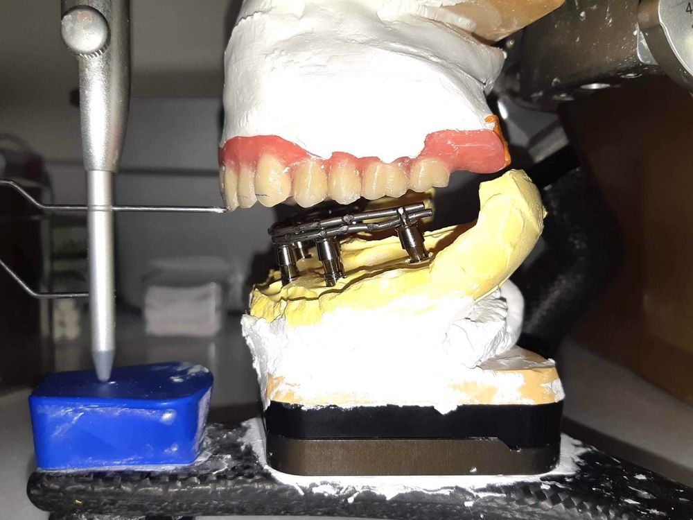 全口重建(All on 4/6) 案例