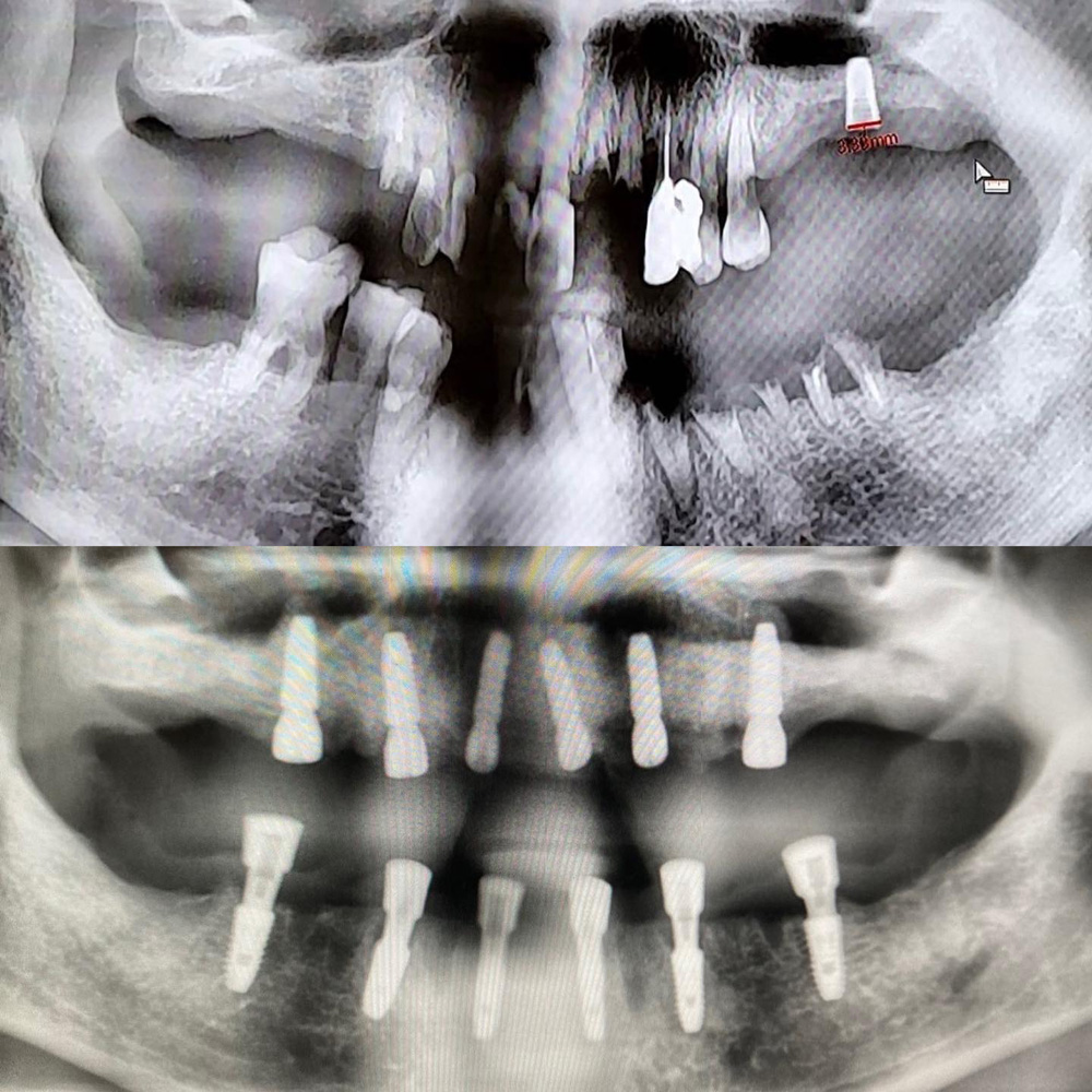 全口重建(All on 4/6) 案例