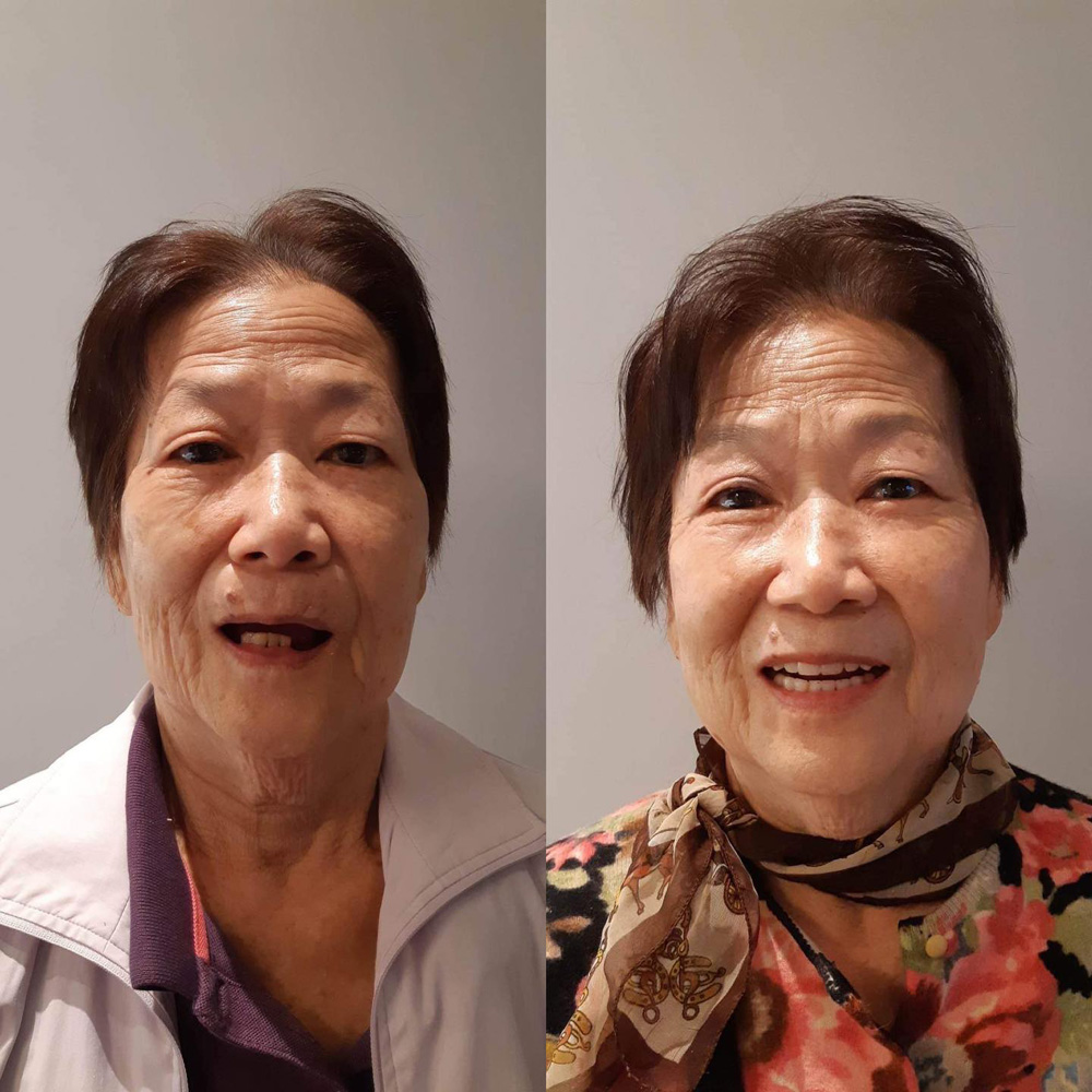 全口重建(ALL ON 4/6) 案例