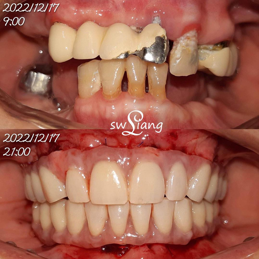 全口重建(ALL ON 4/6) 案例