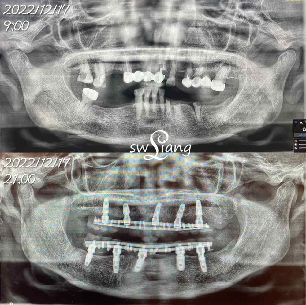 全口重建(ALL ON 4/6) 案例
