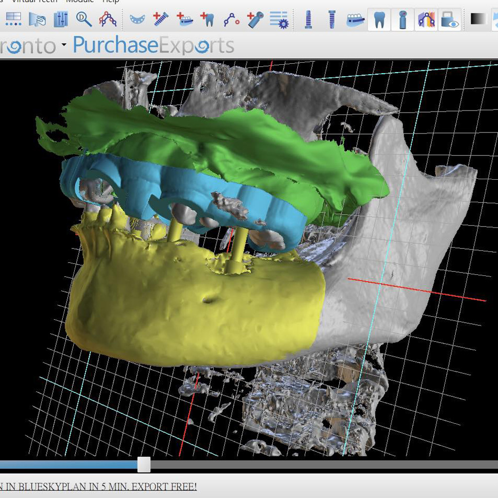 全口重建(ALL ON 4/6) 案例