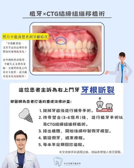 【前牙美學救援】牙齒斷裂怎麼辦？