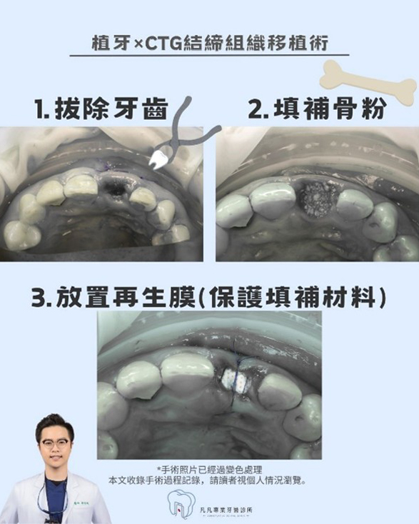 【前牙美學救援】牙齒斷裂怎麼辦？