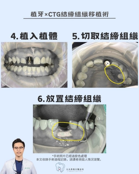 【前牙美學救援】牙齒斷裂怎麼辦？