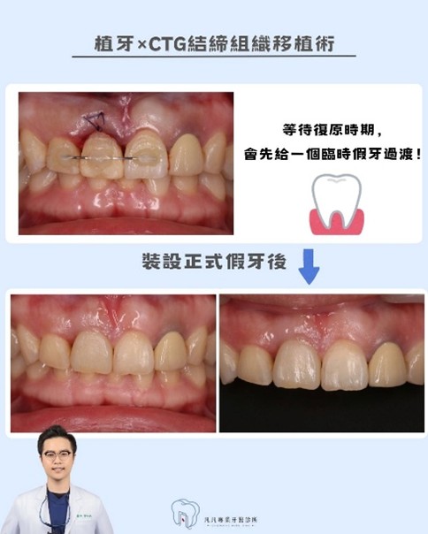 【前牙美學救援】牙齒斷裂怎麼辦？